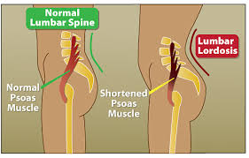 Psoas.jpg