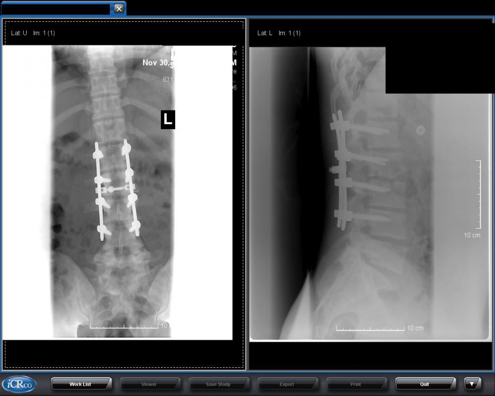 matts_spine_xray_nov302015.jpg